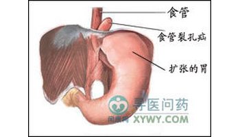 食管裂孔疝