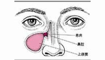 慢性鼻窦炎