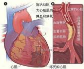 心脏肥大心肌梗塞还有冠心病怎么治疗