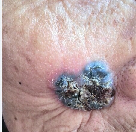 脸上有肿瘤 已经溃烂结疤