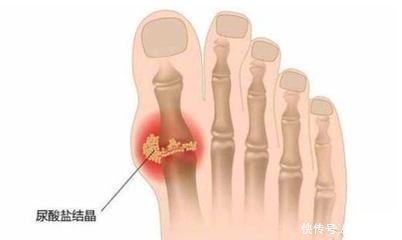 揭开引起尿酸偏高的5个原因,饮食需要注意四