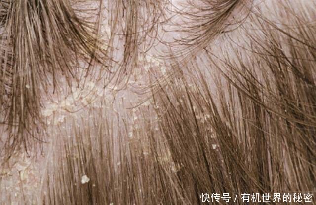 洗头后,拨开头发一看密密麻麻全是头皮屑,2招教你轻松去除它!