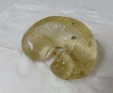 年轻女子身体肿胀,去医院检查,医生检查后发现