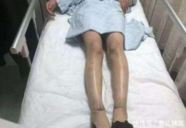 一女子做完鱼疗后, 腿部开始痛痒难耐, 去医院检查后她立马报警