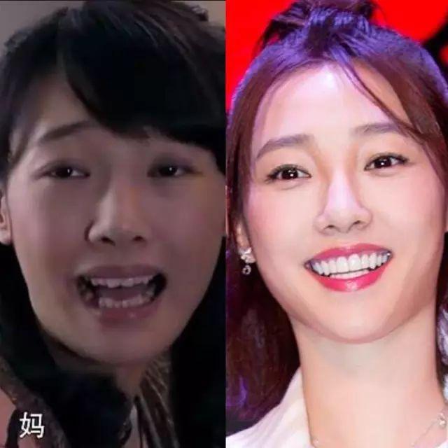 baby跟风做了烤瓷牙?娱乐圈都快被假牙霸占了