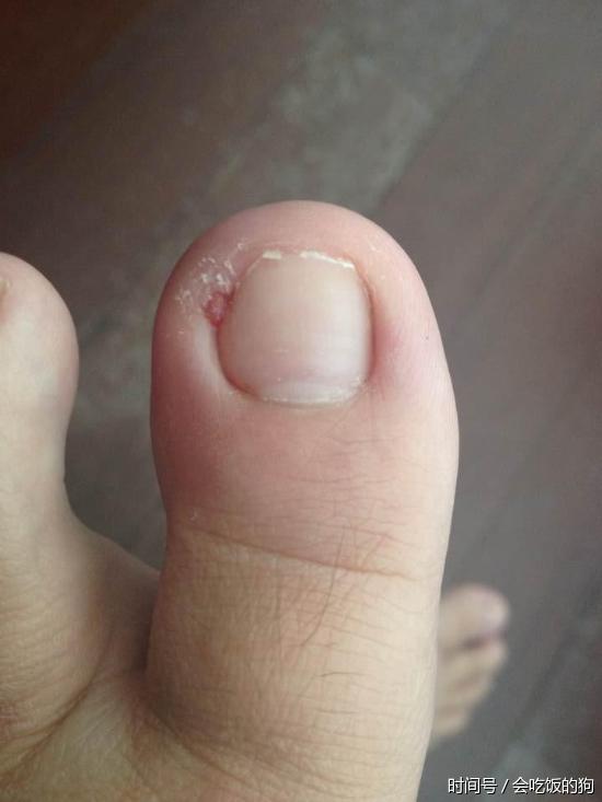 脚趾甲往肉里长又疼又痒? 教你一招自己轻松解决! - 平淡无奇 - 平淡无奇博客 脚趾甲往肉里长又疼又痒? 教你一招自己轻松解决! - 平淡无奇 - 平淡无奇博客