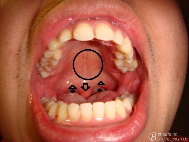 腭舌弓腭咽弓中间的地方就是腭扁桃体.就是我们通常所说的扁桃体.