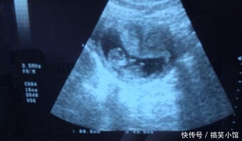 产检被告知腹中胎儿是畸形,家人劝说引产,宝宝