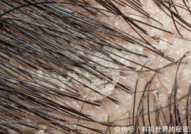 洗头后,拨开头发一看密密麻麻全是头皮屑,2招教你轻松去除它!