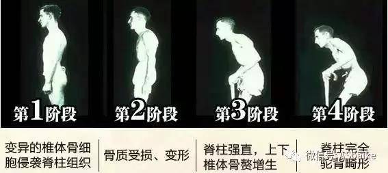 强直是不是真的\＂没救了\＂?来看看别人是如何活成人生赢家的