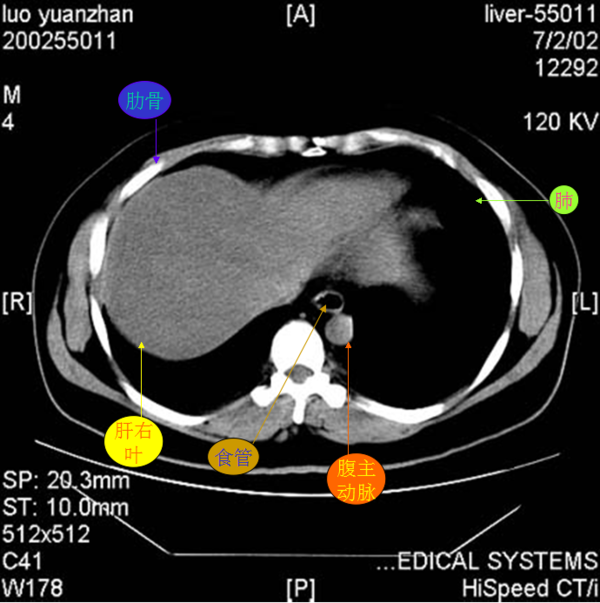 正常的肝脏在ct显示是什么形状的_360问答