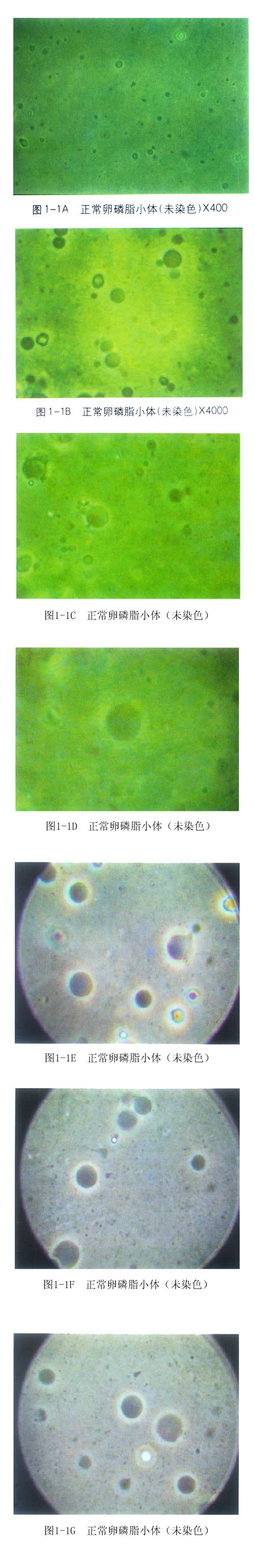 简介 正常的卵磷脂小体(normalcorpusclesoflecithin)呈圆球形或卵