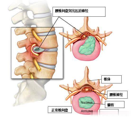腰突病的明明是腰，为什么会腿痛腿麻?