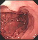 正常胃粘膜形成很多折皱,称皱襞(gastric folds,plicae gastricae)