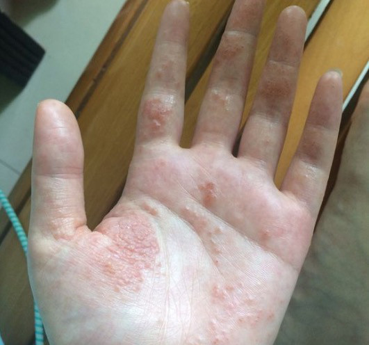 手部皮肤真菌感染图片_手部皮肤真菌感染
