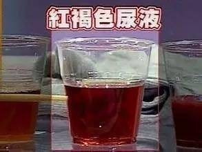 男童排出红褐色酱油尿 就因为吃了怪味豆