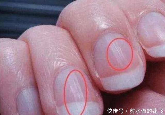指甲盖上长满竖纹,可能是4种疾病引起,现在清
