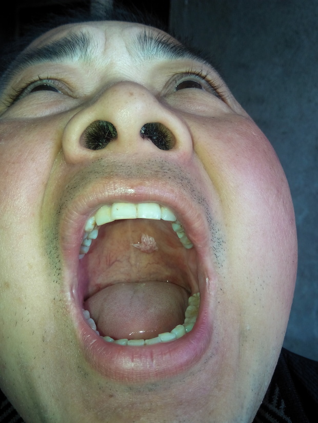 口腔内壁上腭的那个异物是什么?是病毒性感染