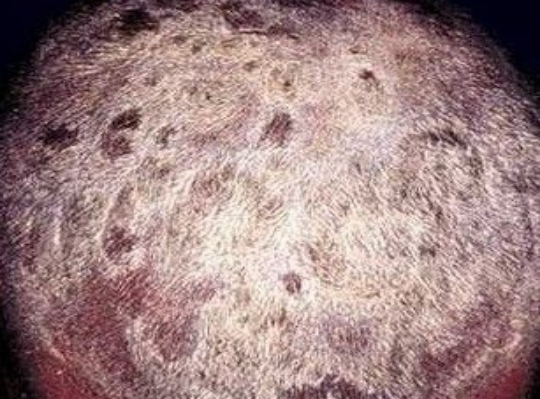 3,黑点癣:为多数散在点状鳞屑斑,病发出头皮即折断,呈黑色小点状.