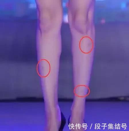 李小璐穿短裙露膝盖登台,小腿部位三处淤青伤