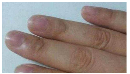 当你手上有这几种症状时，快点去医院看病，别怪老中医没提醒你，