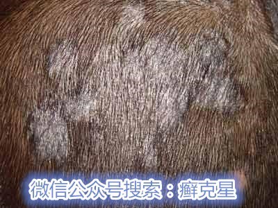 头癣都是什么原因引起的