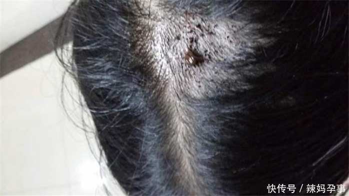 4岁女孩反复高烧, 医生从头上取出这东西, 爸妈