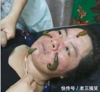 女子脸上长满了痘痘去医院求助, 医生拿出一物, 女子被吓的不轻