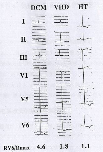 一文纵览:8种心肌病的心电图表现