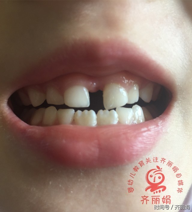 宝宝扎乳牙可牙缝宽的能塞硬币,婆婆说是好事,医生也说是好征兆