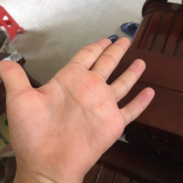 左手指神经受损,肌肉萎缩怎么办?急急急