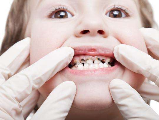七岁小孩子很少吃糖, 但牙齿全烂了, 医生气愤的