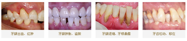 牙龈改变:正常牙龈粉红色,菲薄而紧贴牙面,附着龈有点彩.