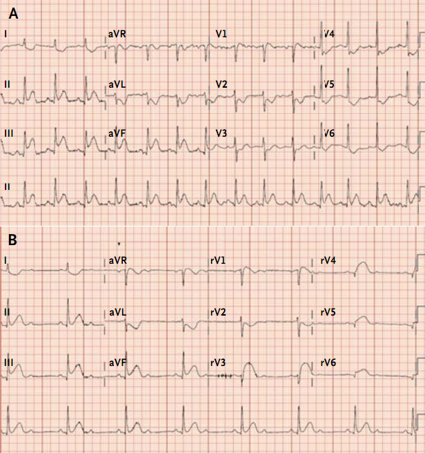 右室梗死的诊断和治疗,把握好这几个方面