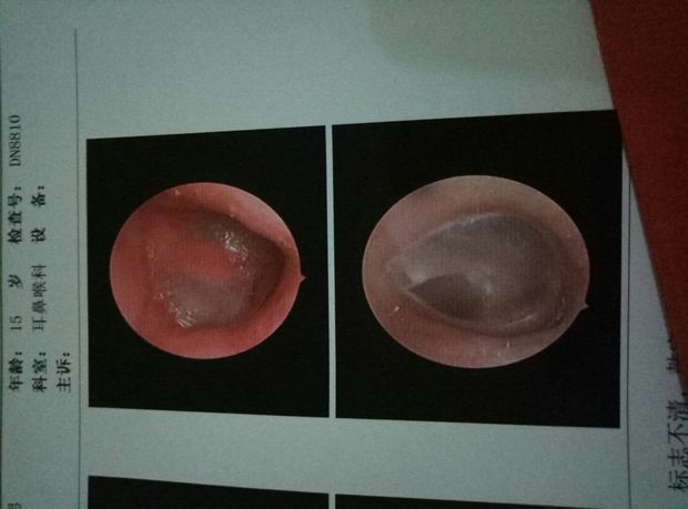 中耳炎流脓,感觉耳朵被堵住了_360问答