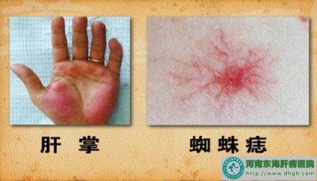 酒精性肝炎早期症状_传染科_题库www.teaku.