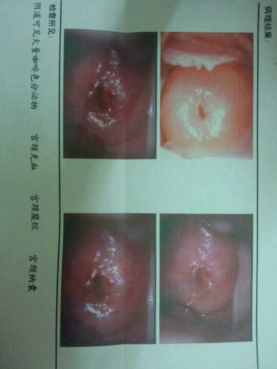 结果说宫颈糜烂,有些害怕,医生又说很严重.