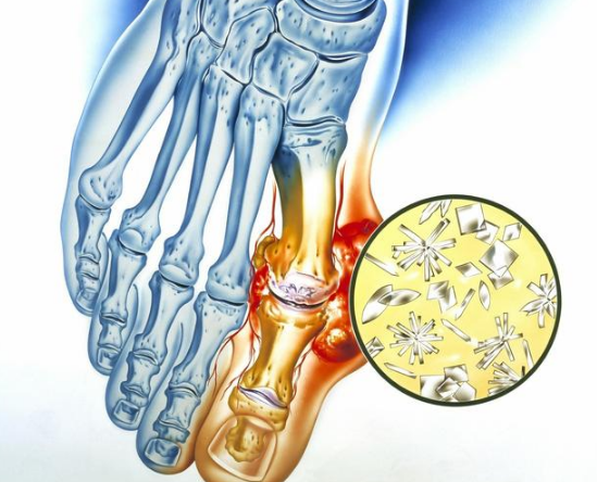 大家都抽烟喝酒吃海鲜,为什么就我得痛风?