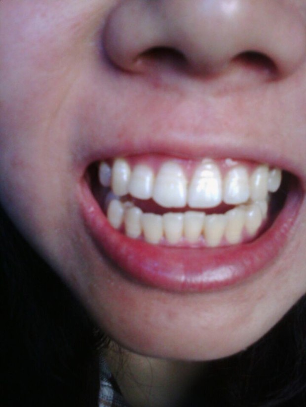 矫正牙齿。我想问下我的拔不拔牙矫正。我觉得