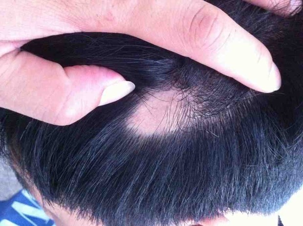 <em>头发脱</em>的这么<em>厉害,怎么办</em>啊-