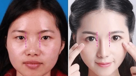 咋整呢呵呵 第二季 堪比整容的开眼角手术 一键放大双眼