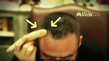 咋整呢呵呵 第二季 拯救杨幂尴尬的发际线 离不开植发