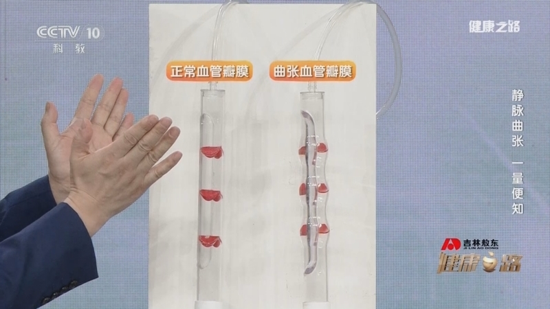 《健康之路》 20251201 静脉曲张 一量便知
