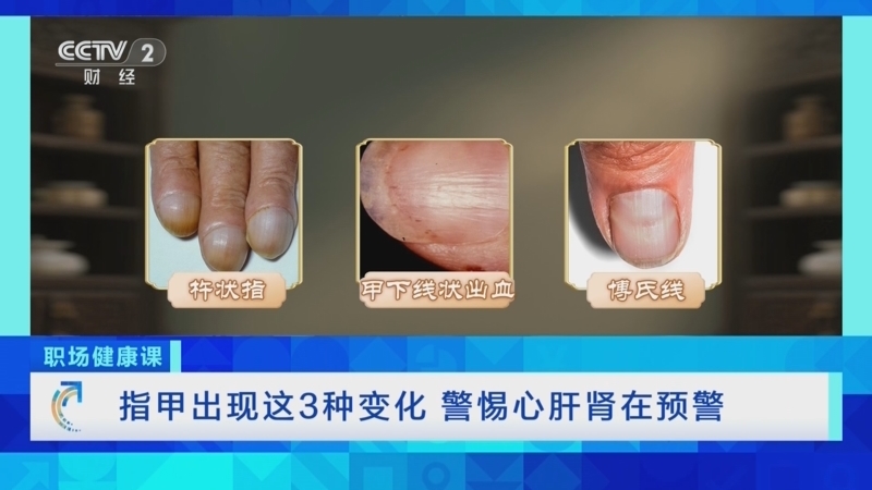 《职场健康课》 20260419 指甲出现这3种变化 警惕心肝肾在预警