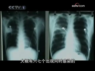 见证 SARS背后的秘密 第1集