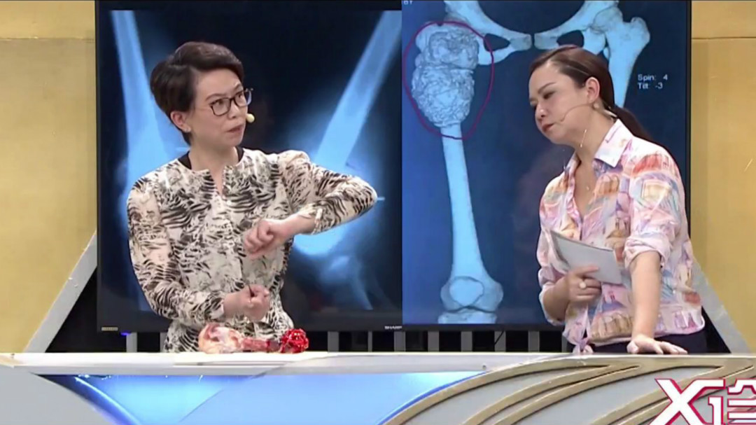 X诊所. 《心肝宝贝》特辑 闯进现代生活的远古肿瘤