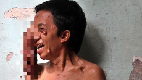 涨健识 男子脸部长巨瘤如象鼻
