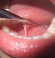 舌下肉阜解剖图图片