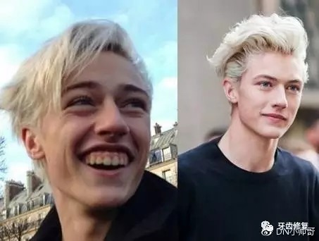 不想被大黄牙影响生活和工作的,接着往下看! 一口牙,毁一张脸!