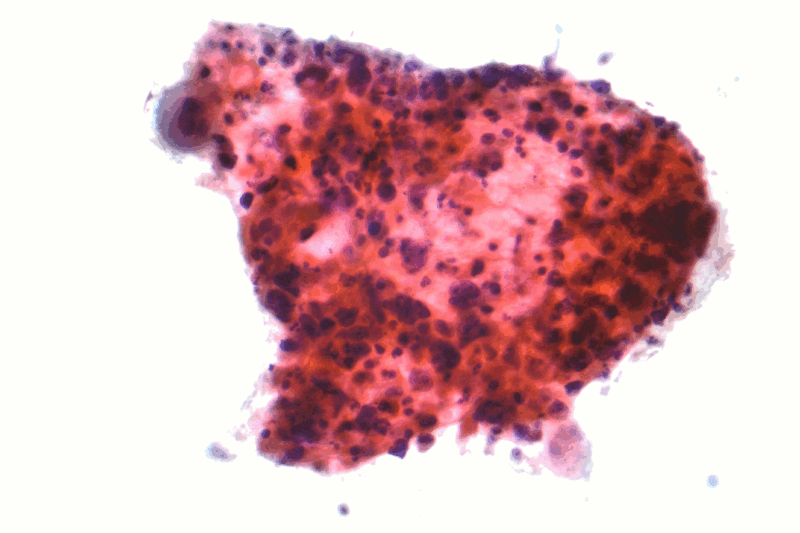 中分化肺鳞癌图片